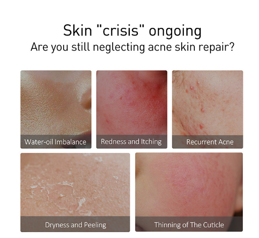 Naturevra Calm & Clear Toner – Tónico facial con árbol de té para piel con granos